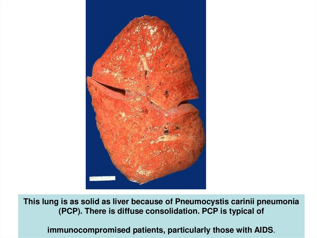 This lung is as solid as liver because of Pneumocystis carinii pneumonia (PCP). There is diffuse consolidation. PCP is typical