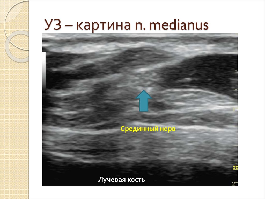 УЗ – картина n. medianus