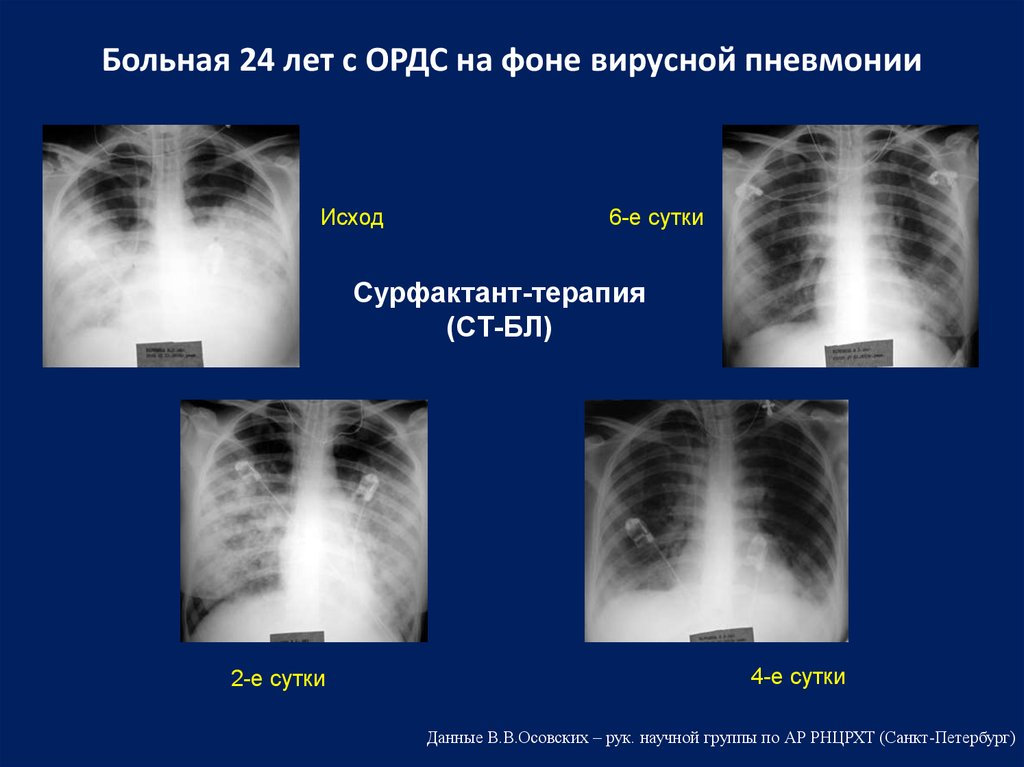 Умирают ли от пневмонии. Вирусная пневмония. Двусторонняя вирусная пневмония. Вирусная пневмония при коронавирусе. Двухсторонняя пневмония степени.