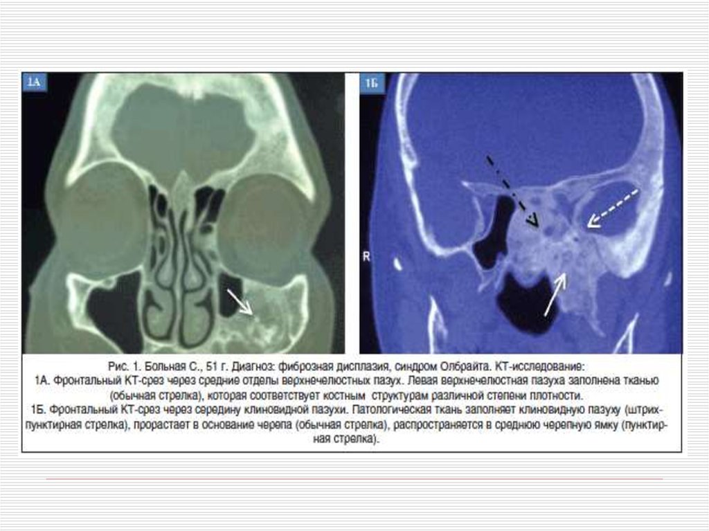 Фиброзная дисплазия. Фиброзная дисплазия черепа рентген. Фиброзная дисплазия височной кости кт. Фиброзная дисплазия черепа кт. Фиброзная дисплазия костей черепа рентген.