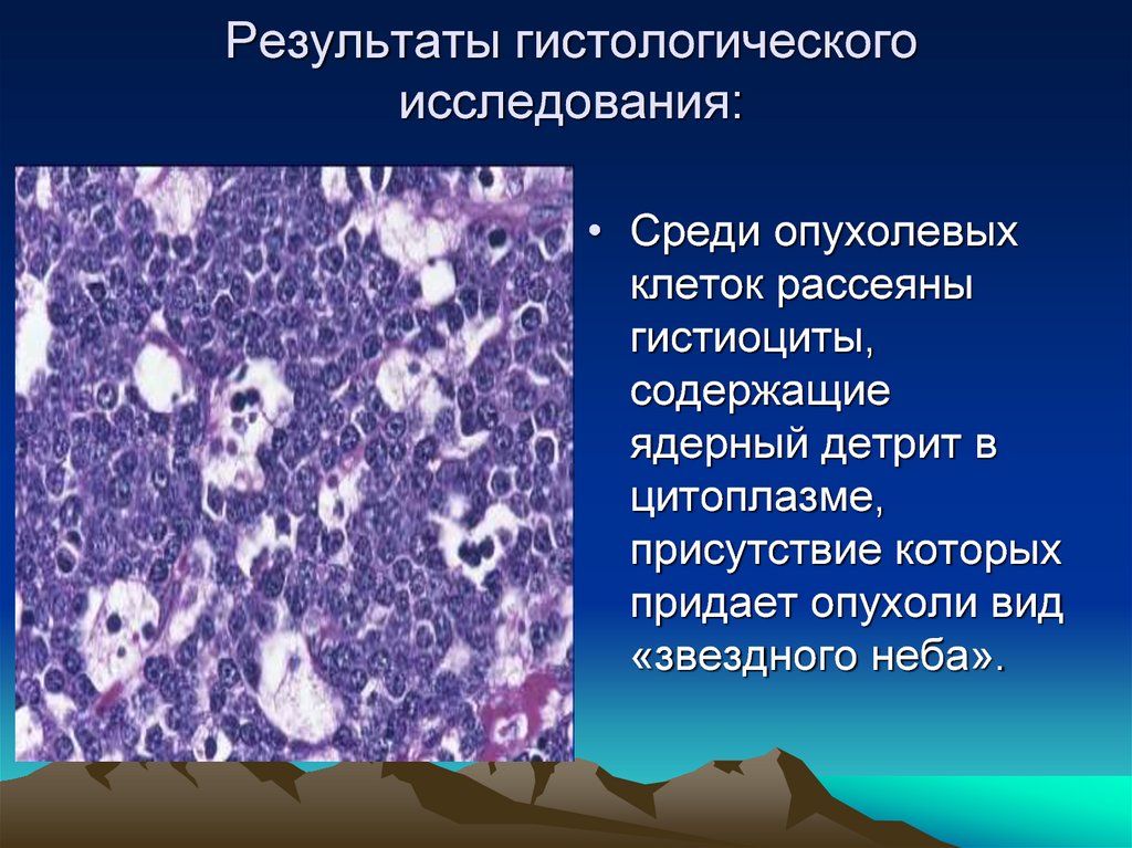 Гистологическая картина звездного неба наблюдается при