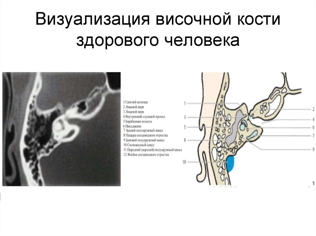 Кт височных костей