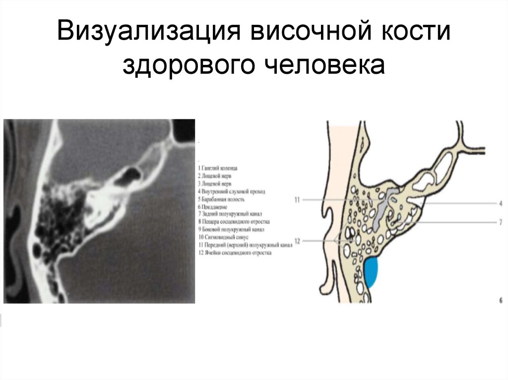 Изменения височной кости. Анатомия ячеек сосцевидного отростка на кт. Ячейки сосцевидного отростка височной кости. Антрум височная кость кт. Рентген сосцевидного отростка височной кости.