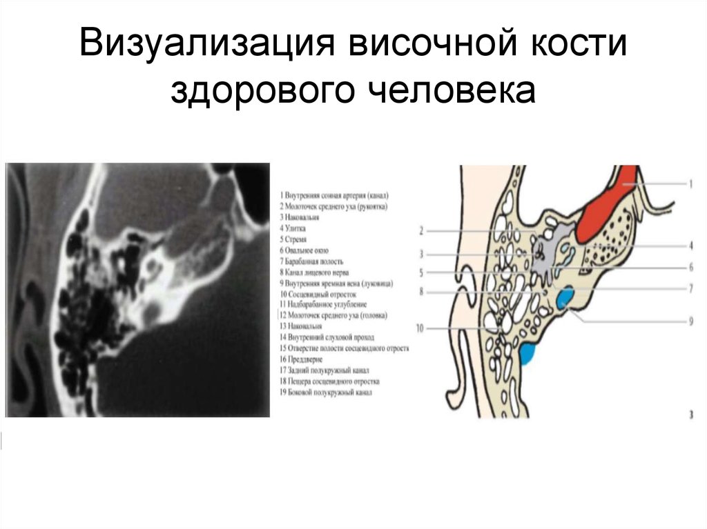 Изменения височной кости. Сосцевидный отросток анатомия строение. Анатомия сосцевидного отростка височной кости на кт. Сосцевидный отросток височной кости кт. Кт анатомия сосцевидного отростка.