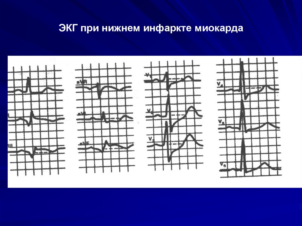 Индекс макруза. Индекс Макруза при гипертрофии левого желудочка. Индекс Макруза при гипертрофии левого предсердия. Нижний инфаркт. Индекс Макруза на ЭКГ.