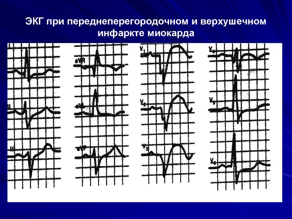 Перегородочный инфаркт экг. Переднеперегородочный инфаркт миокарда на ЭКГ. Q инфаркт миокарда переднеперегородочный ЭКГ. Передне переоородочный инфаркт. ЭКГ при переднеперегородочном инфаркте.