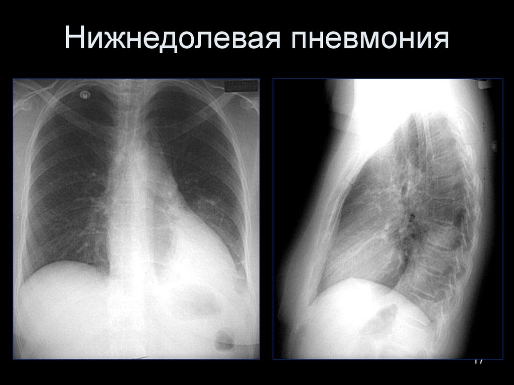 Нижнедолевая пневмония