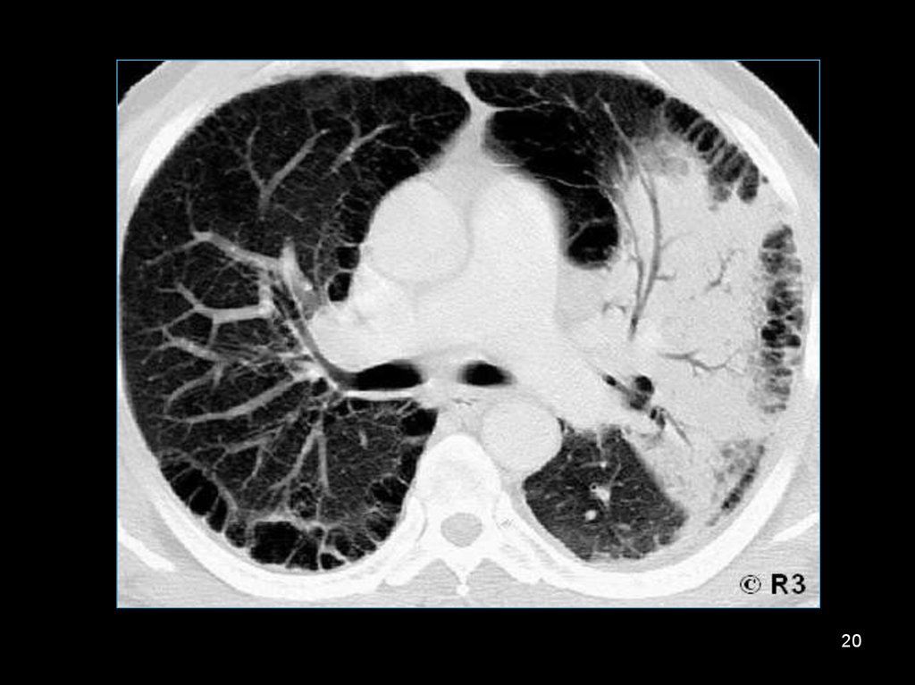 C pneumoniae