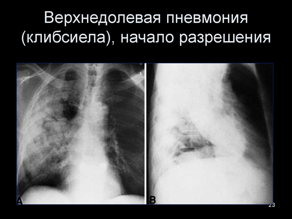 Верхнедолевая пневмония. Рентген верхнедолевой правосторонней пневмонии. Левосторонняя верхнедолевая пневмония рентген. Верхнедолевая очаговая пневмония.