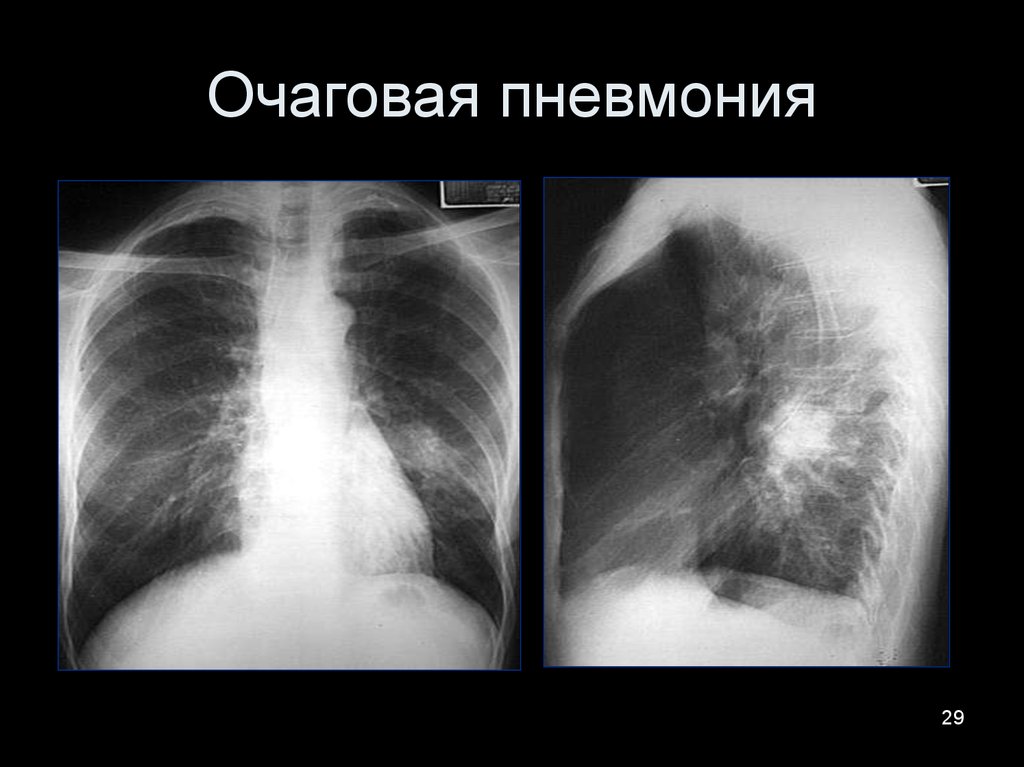 Очаговая пневмония