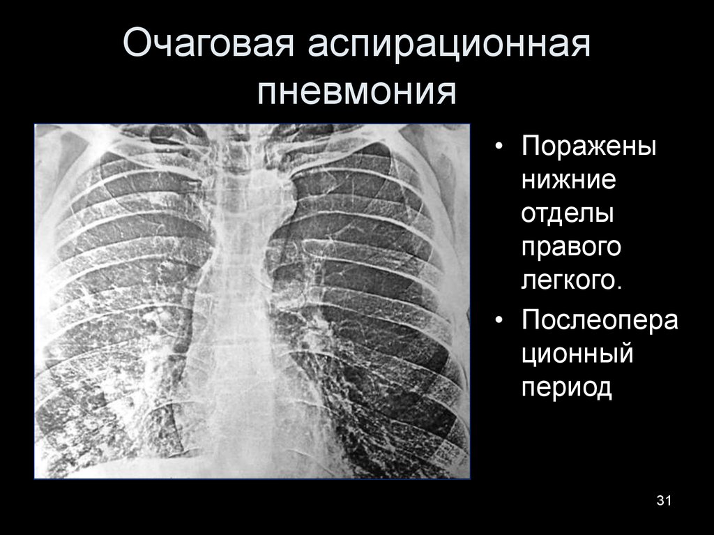 Пневмония очаговая презентация