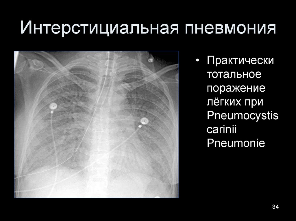 Картина двусторонней полисегментарной интерстициальной пневмонии