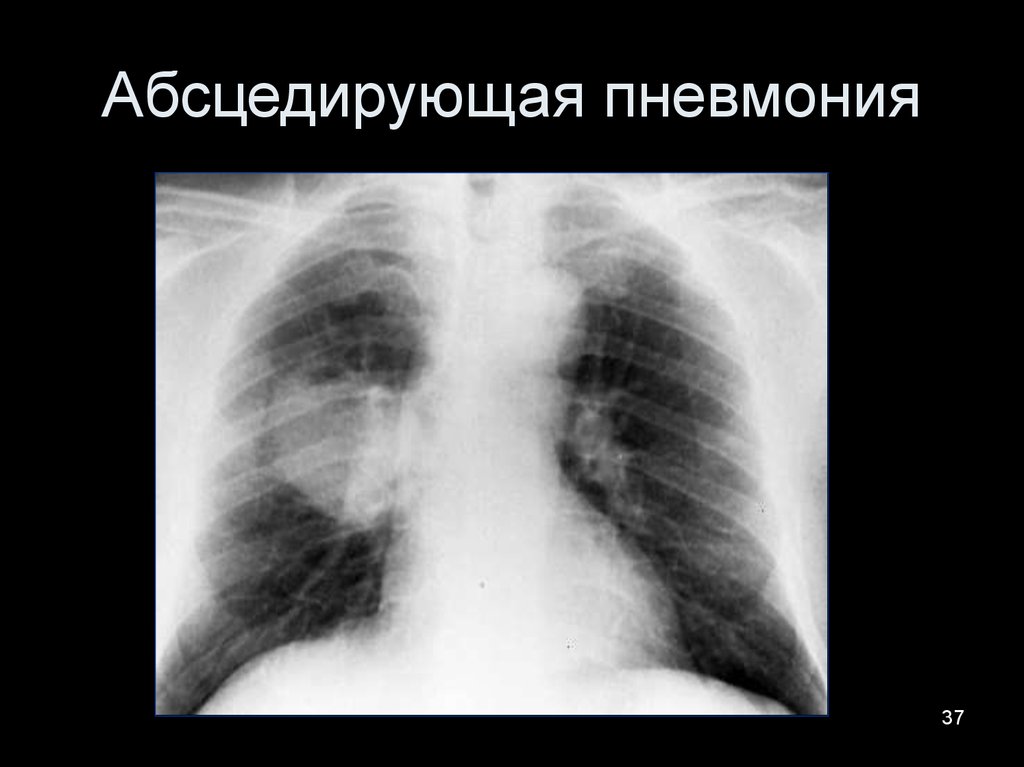 Рентген картина пневмонии