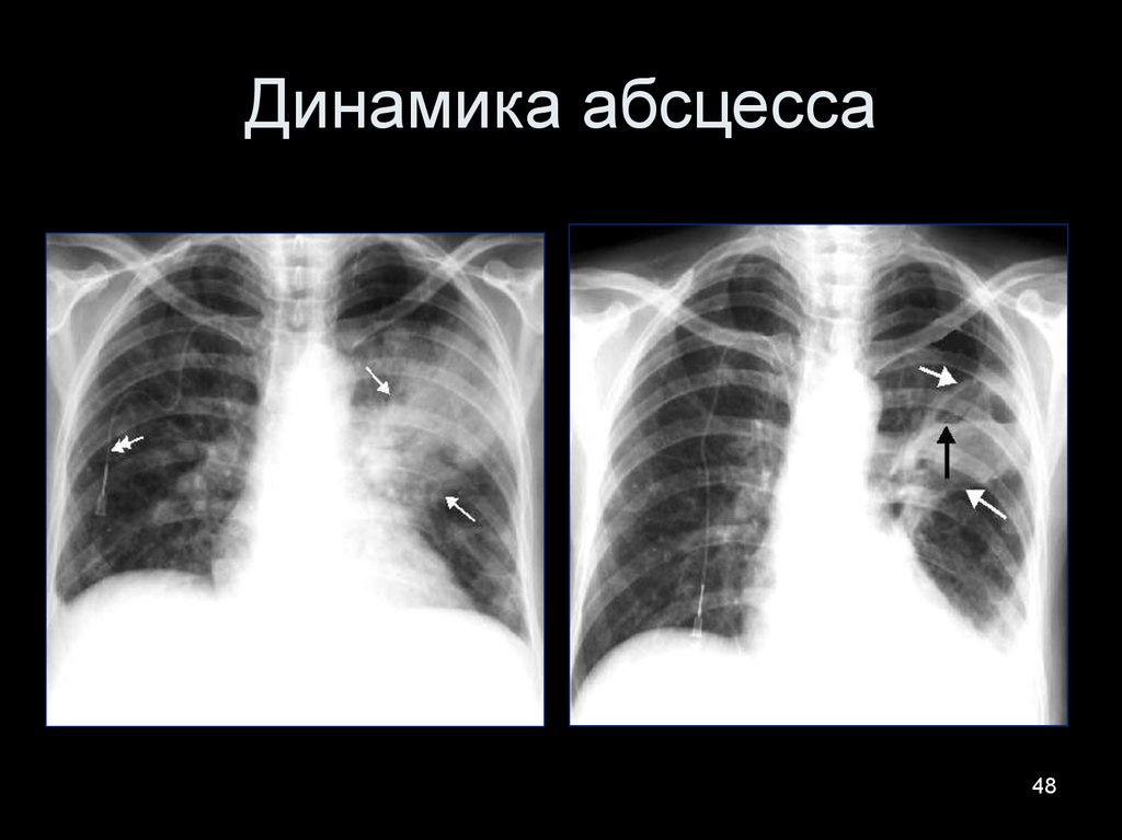 Динамика абсцесса