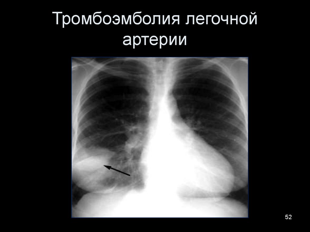 Тромболия легочной артерии. Инфаркт легкого при Тэла рентген. Инфаркт-пневмония легкого рентген. Рентгенодиагностика Тэла. Тромбоэмболия лёгочной артерии симптомы рентген.