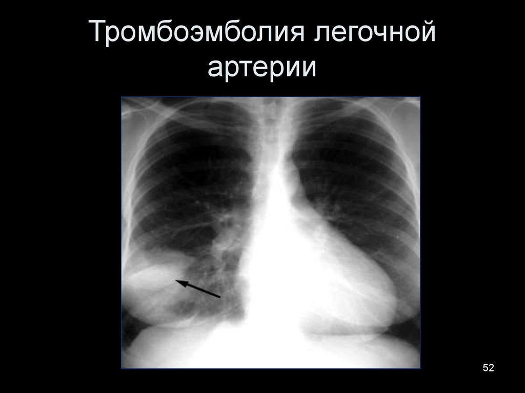 Тромбоэмболия легочной артерии. Рентгенография органов грудной клетки при Тэла. Рентгенодиагностика Тэла. Симптомом тромбоэмболии легочной артерии на рентгене. Рентгенограмма легких при Тэла.