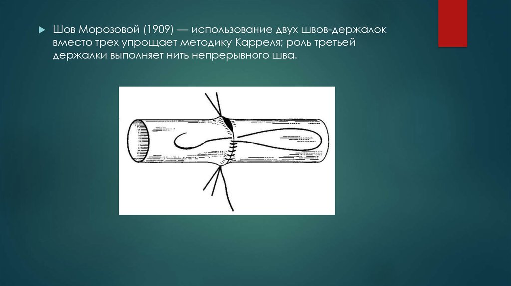 Использование 2. Сосудистый шов по Каррелю и Морозовой. Шов сосуда по Каррелю Морозовой.