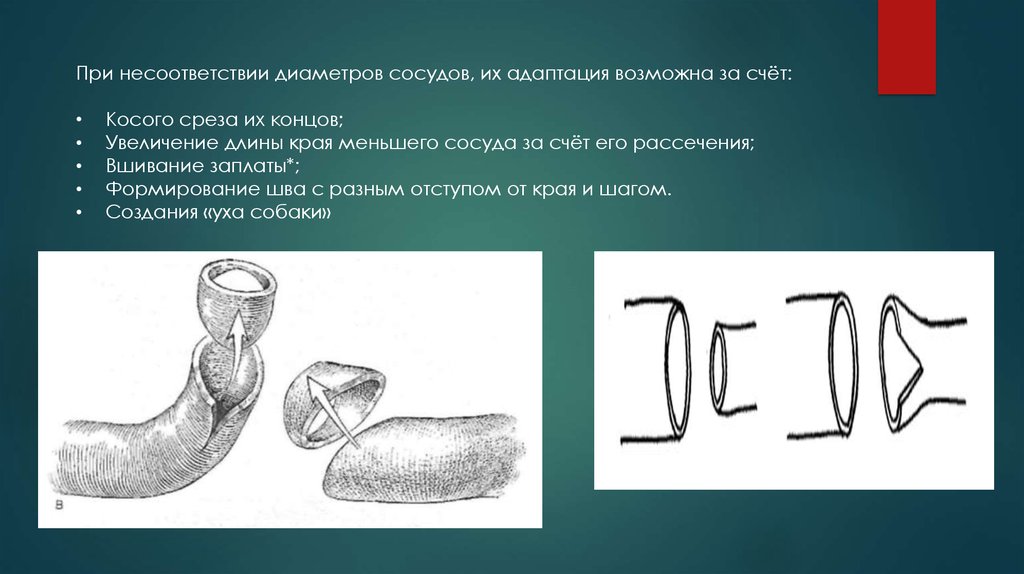 Диаметр сосуда. Диаметр сосудов. Наложение сосудистого шва при несоответствии диаметров сосуда. При несоответствии.