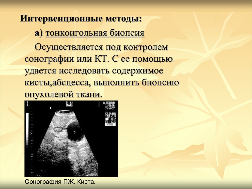 Сонография это. Интервенционная сонография. Интервенционная сонография абсцесса. Абсцесс печени сонография. Интервенционные вмешательства под контролем УЗИ.