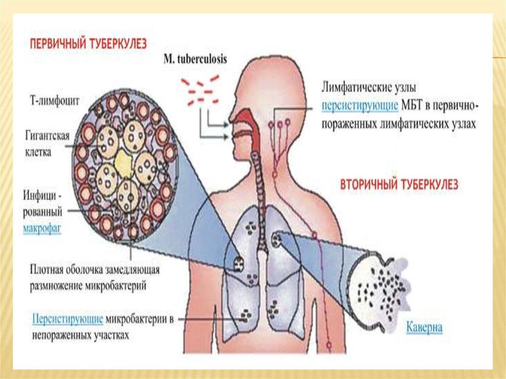Заболевание туберкулез у человека вызывает