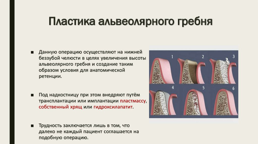 Методы фиксации и стабилизации съемных протезов при полном отсутствии зубов презентация