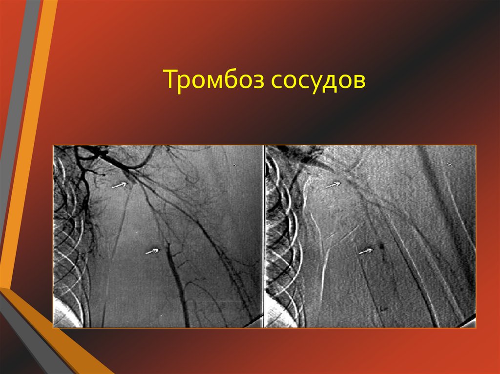 Тромбоз артерия и вена