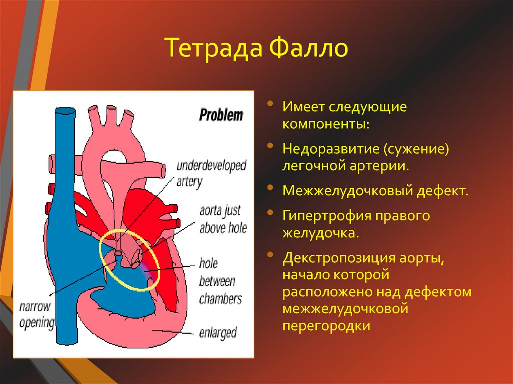 Тетрада фалло презентация