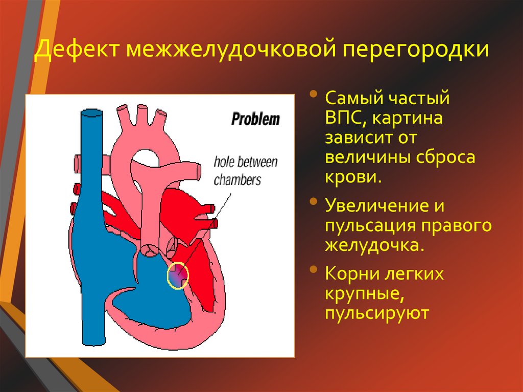 Дефект межжелудочковой перегородки