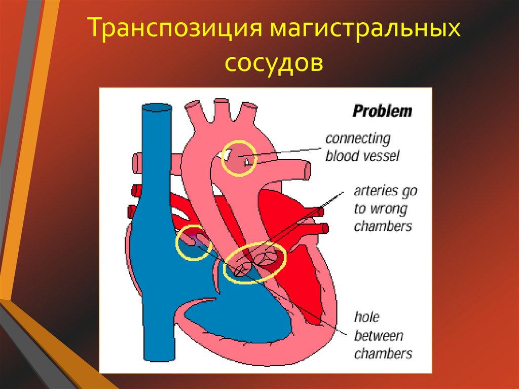 Транспозиция артерий