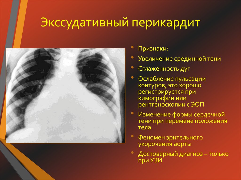 Туберкулезный перикардит презентация