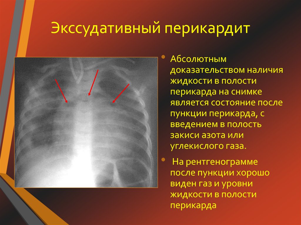 При выпотном перикардите на рентгенограмме наблюдается легочный рисунок тест ответ