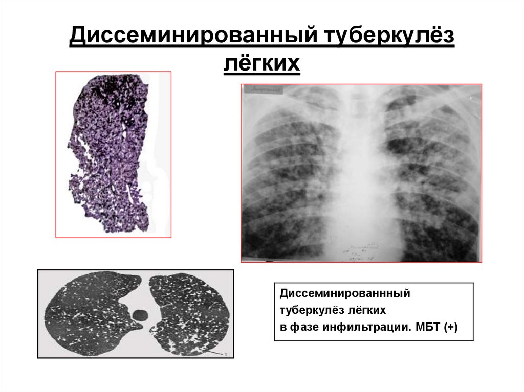 Диссеминированный туберкулез фаза инфильтрации. Гематогенно диссеминированный туберкулез рентген. Диссеминированный туберкулез. Лимфогенный диссеминированный туберкулез рентген. Подострый диссиминированный туберкулёз рентген.