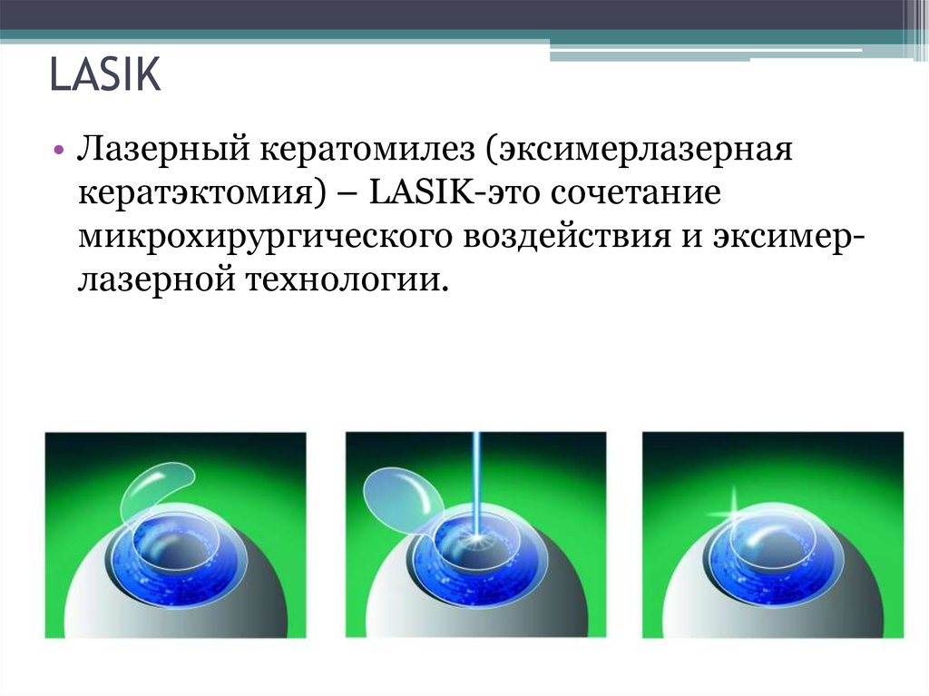 Минусы лазерной. LASIK лазерный кератомилез. Лазерный интрастромальный кератомилез (ласик). Гиперметропический лазерный кератомилез. LASIK лазерный кератомилез in situ.