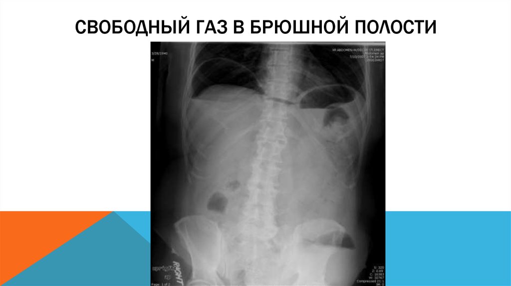 Свободная брюшная полость. Свободный ГАЗ В брюшной полости. Свободный ГАЗ В брюшной полости на рентгенограмме. Свободный ГАЗ В брюшной полости рентгенодиагностика. Свободный ГАЗ В брюшной полости на УЗИ.