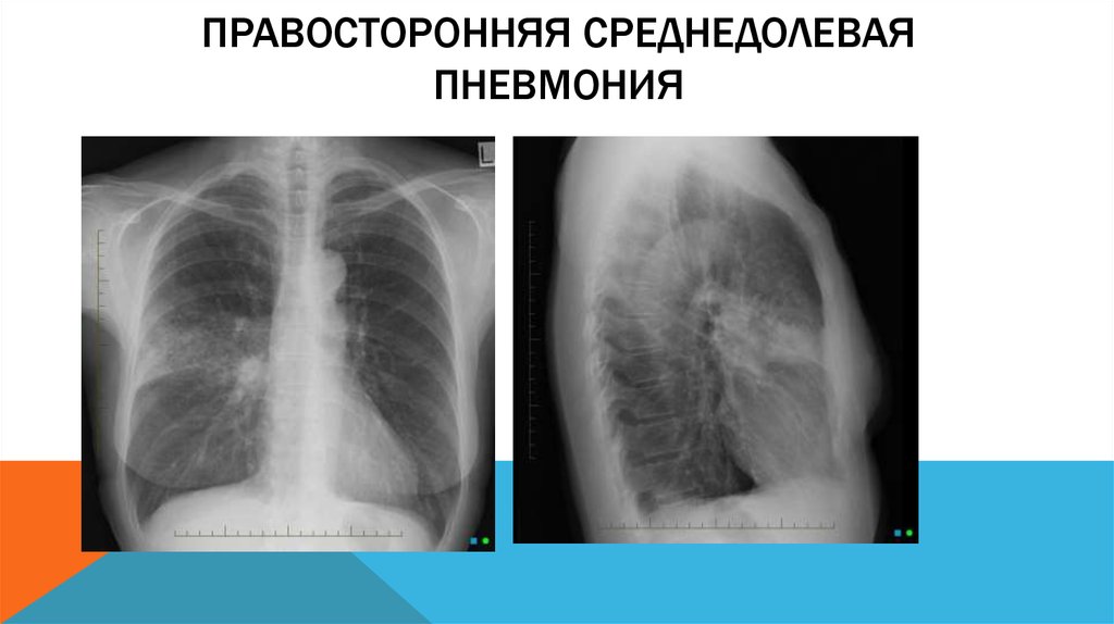 Рентген диагностика пневмоний. Правосторонняя нижнедолевая очаговая пневмония рентген. Правосторонняя среднедолевая пневмония рентген. Долевая пневмония рентген. Среднедолевая пневмония на рентгенограмме.