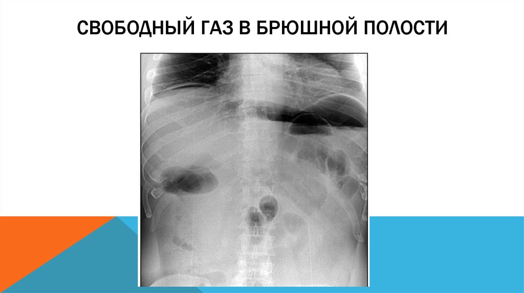 Свободная брюшная полость