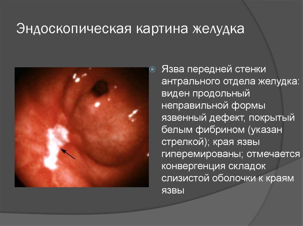 Эндоскопическая картина желудка