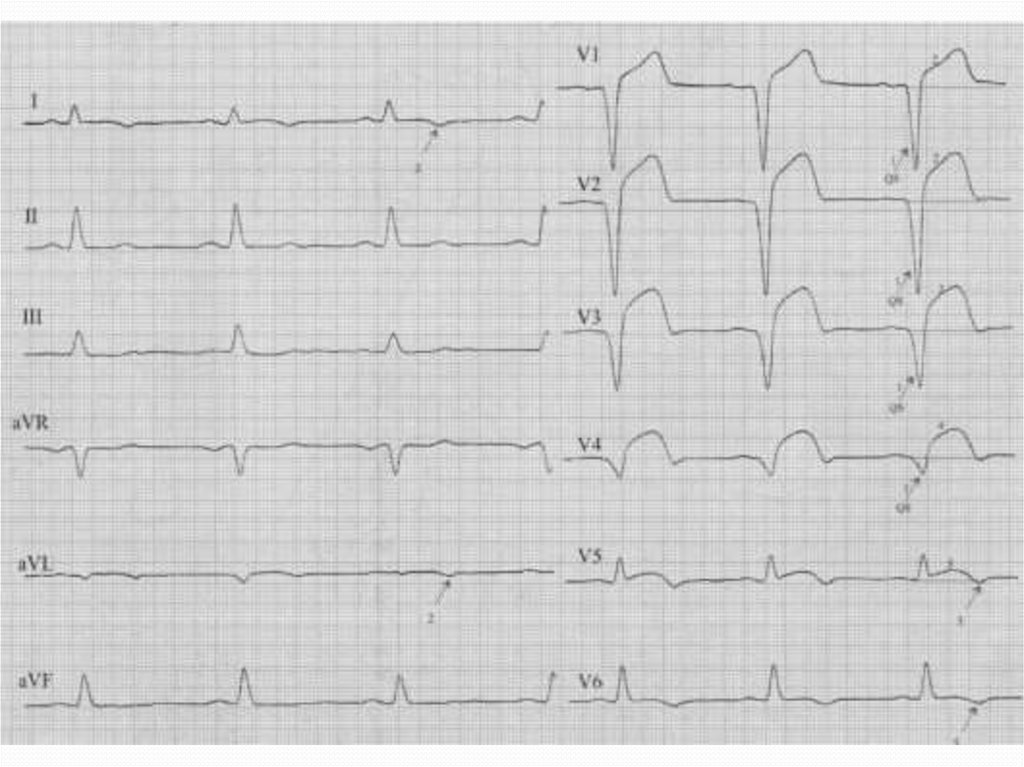 Экг миокард. Передний инфаркт миокарда на ЭКГ. Подострая стадия инфаркта на ЭКГ. ЭКГ инфаркт миокарда передней перегородки. Острый инфаркт миокарда передней стенки ЭКГ.