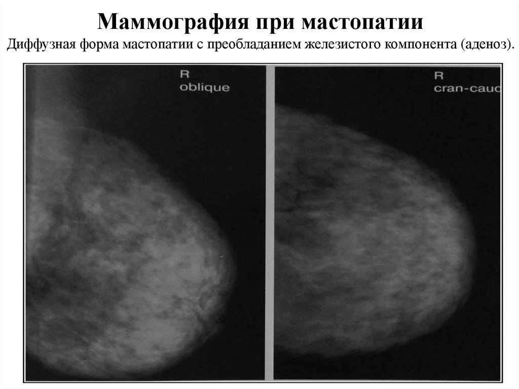 Маммография молочных желез 4. Маммография. Маммография молочной железы. Маммограмма нормальной молочной железы. Нормальная маммография молочной железы.