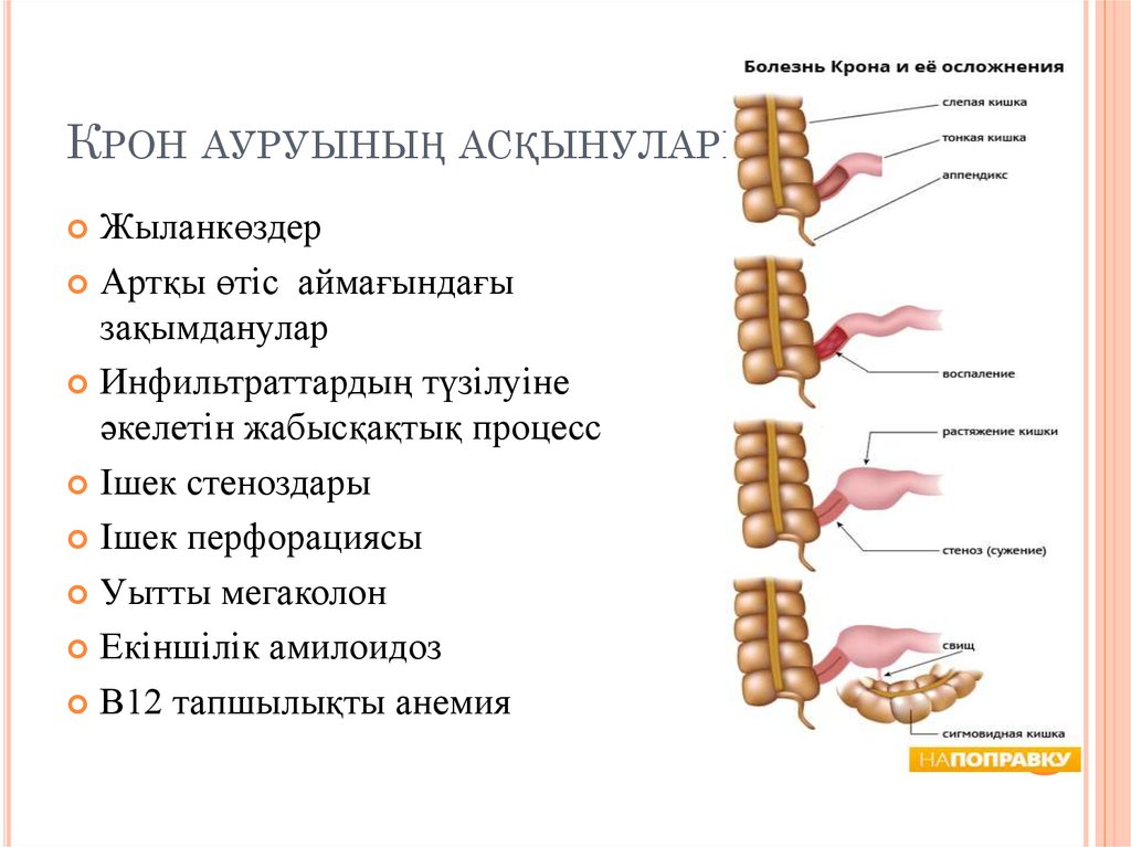 Крон ауруы презентация