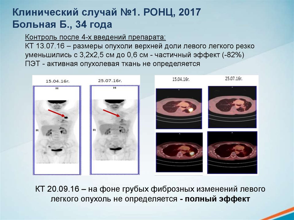 Случай лечения. Псевдопрогрессия опухоли. Клинические случаи в терапии. Если уменьшается размер опухоли легкого. Размер опухоли 2,4х2,2х2,7.