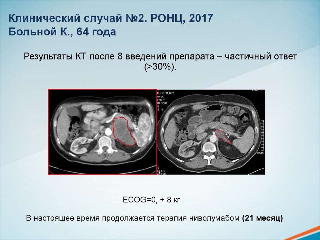 Случай лечения. Ответы после кт. Частичный ответ в онкологии. Ниволумаб псевдопрогрессирование.