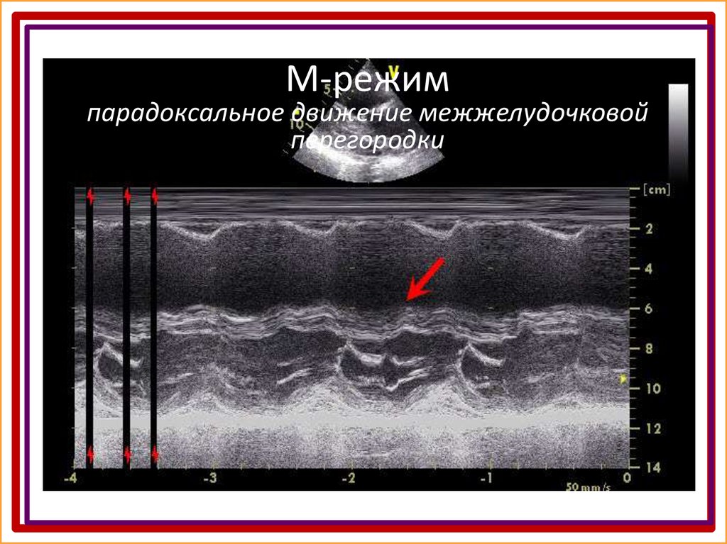 М режим. Парадоксальное движение МЖП на ЭХОКГ. Парадоксальное движение межжелудочковой перегородки. Парадоксальное движение МЖП. Парадоксальное движение межжелудочковой перегородки причины.