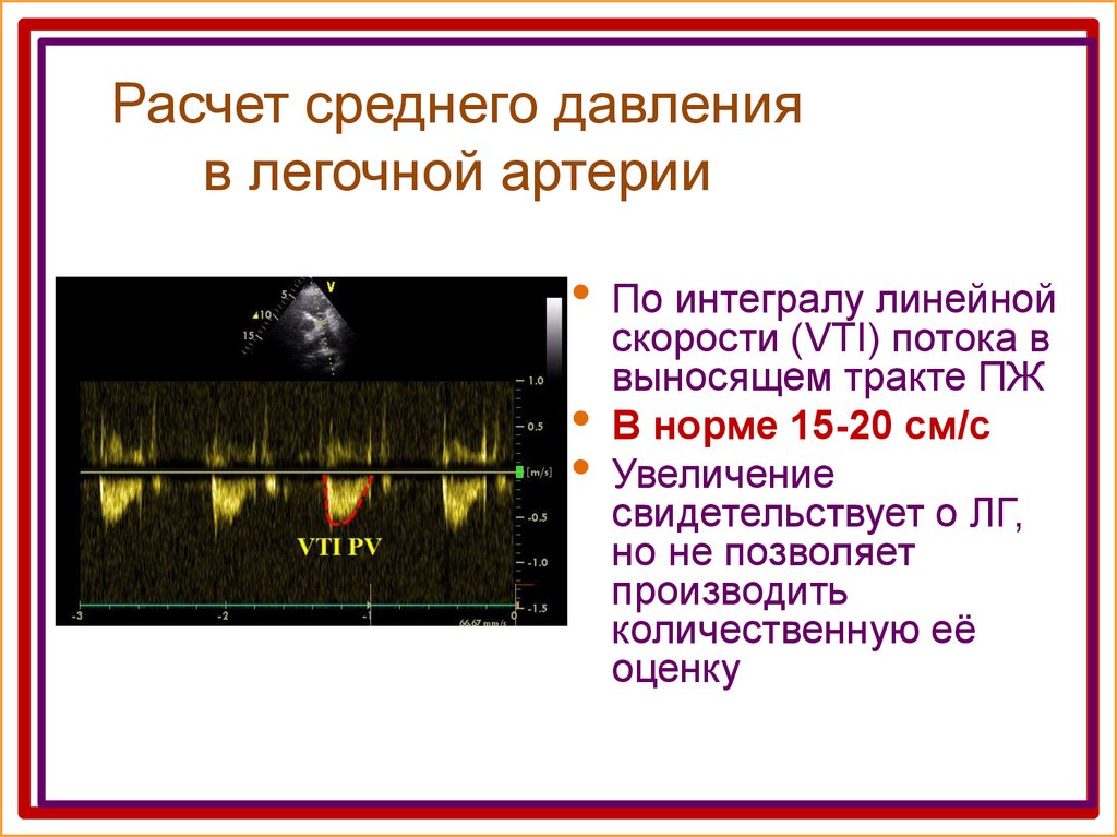 Давление в легочной артерии. Давление в легочной артерии норма на ЭХОКГ. Норма среднего давления в легочной артерии по ЭХОКГ. Градиент давления на легочной артерии в норме. Систолическое давление в легочной артерии норма.