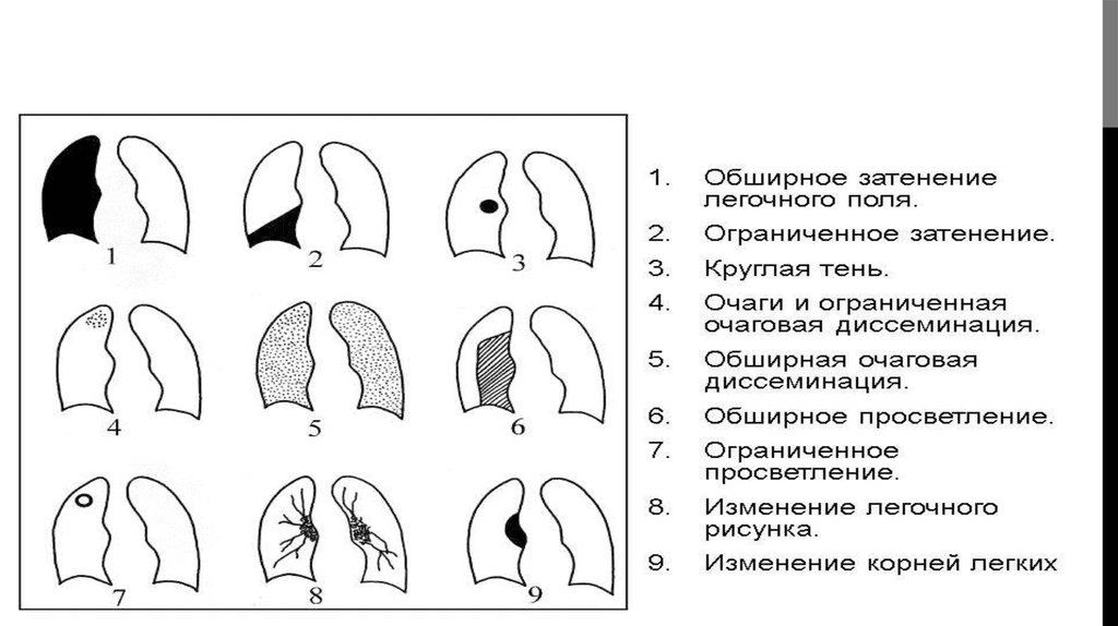 Просветление в легких. Синдром обширного просветления легочного поля. Синдром обширного просветления легочного поля схема. Синдром диффузного просветления легочной ткани. Синдром обширного просветления легочного поля рентген.