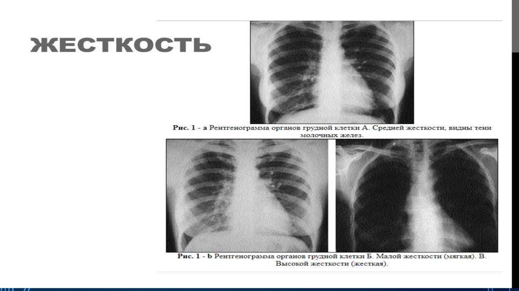Жесткий жесткость. Мягкий рентгеновский снимок. Мягкие и жесткие рентгенограммы. Жесткий рентгенологический снимок. Жесткий и мягкий рентгеновский снимок.