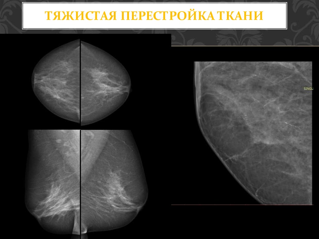 Микрокальцинаты. Тяжистый фиброз молочной железы. Перестройка тканей это. Участок тяжистой перестройки на маммографии. Тяжистая перестройка левой молочной железы.