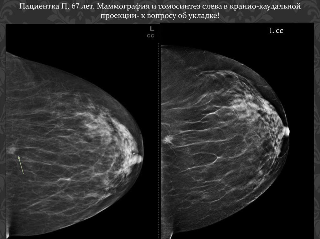 Сколько раз можно маммографию