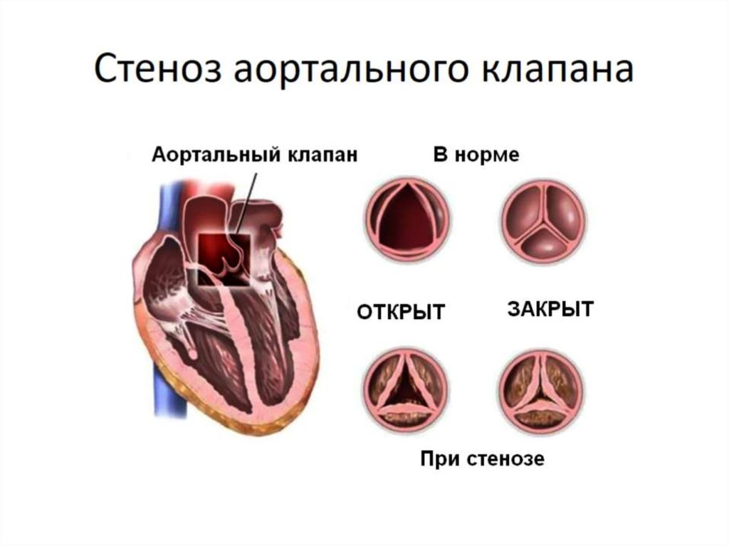 Стеноз аортального клапана