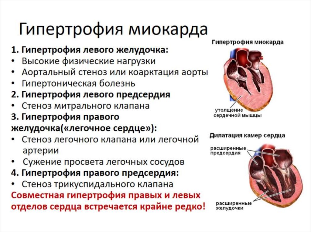 Миокард правого предсердия. Причины гипертрофии миокарда левого и правого желудочка. Масса миокарда левого желудочка при гипертрофии. Клинические признаки гипертрофии миокарда предсердий. Причины гипертрофии правого желудочка сердца.